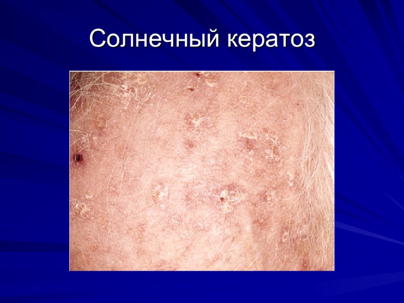 Солнечный кератоз